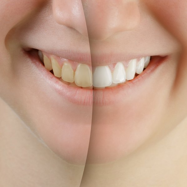 Before and After Showcase of The Teeth Whitening Procedure
